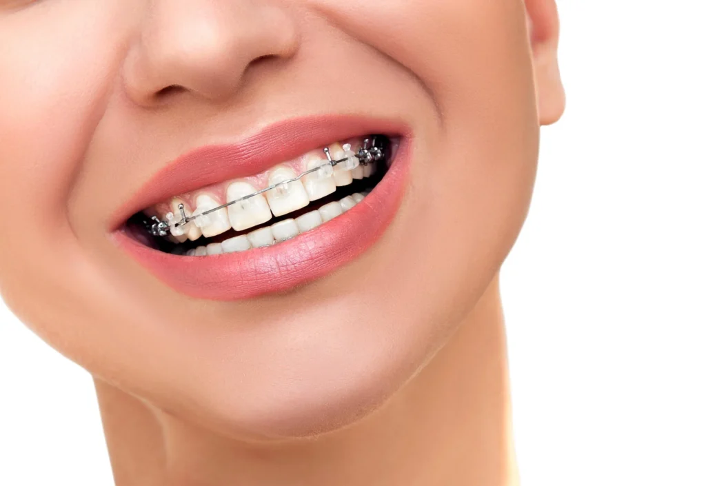 Close-up of ceramic braces on teeth orthodontists in Birmingham