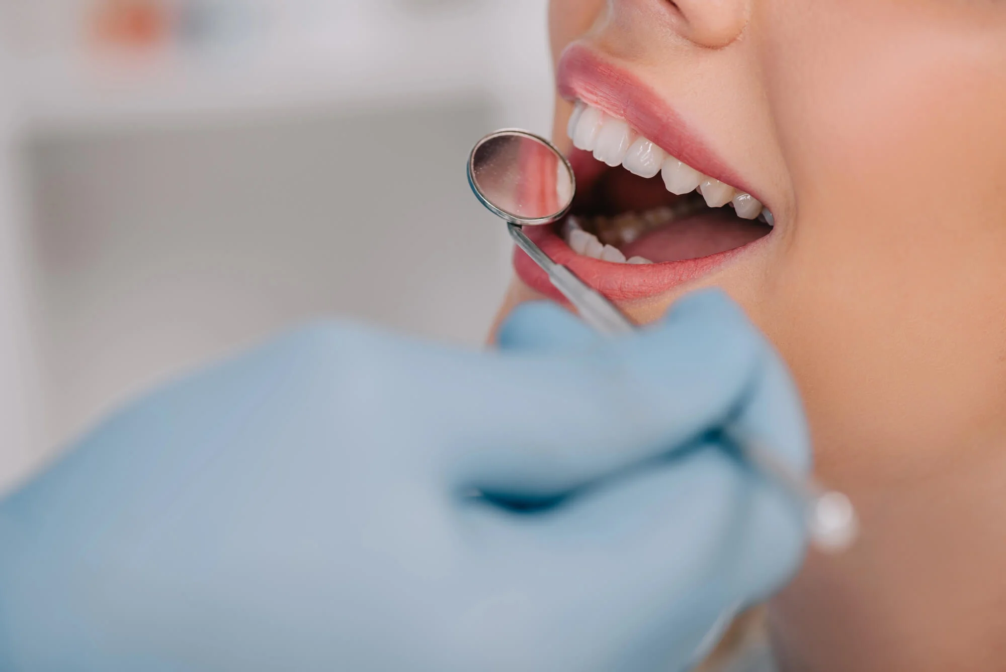 Dental exam with mirror showing patient’s teeth dental bonding college station tx