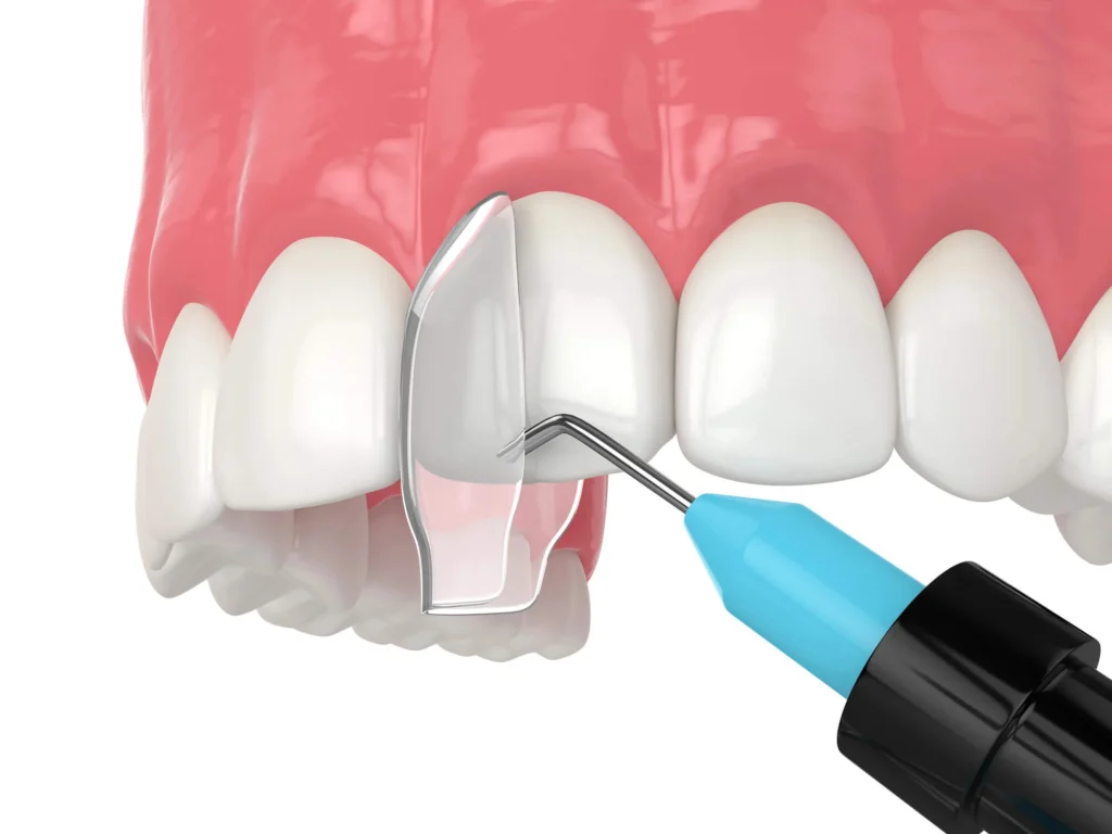 Illustration of dental bonding resin applied to tooth dental bonding Mount Holly.