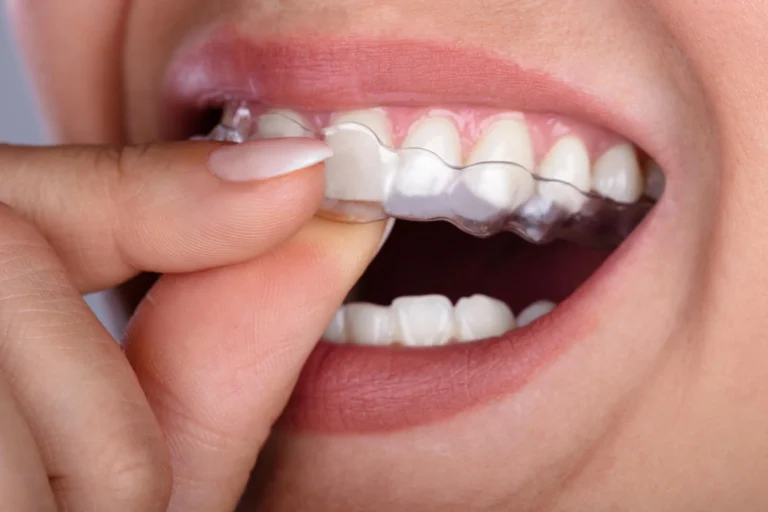 Close-up of clear aligner placed on teeth invisalign in Mount Holly