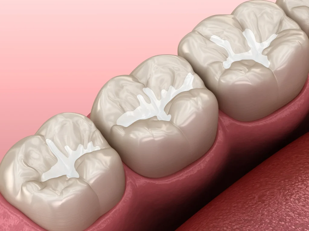 Molars protected with dental sealants in Mount Holly
