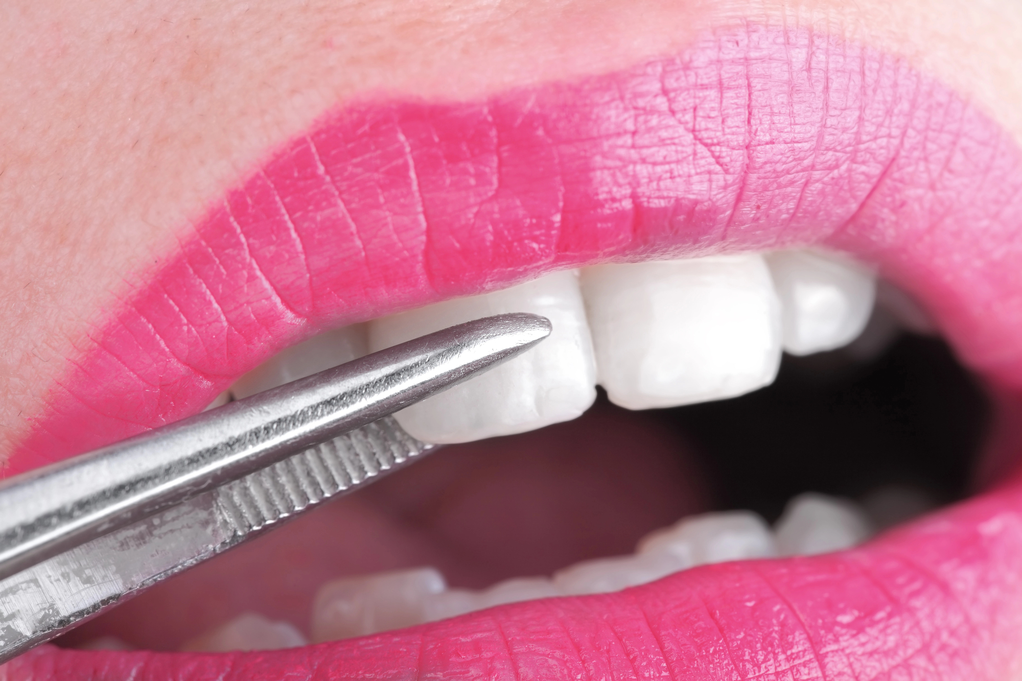 veneer smile cosmetic dentist in Spartanburg