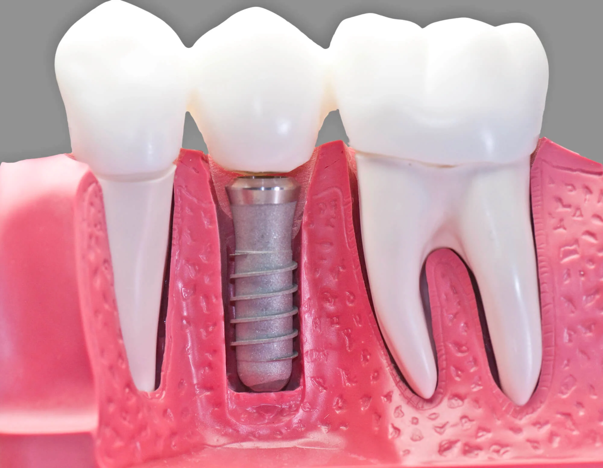 Dental-implant-crown-model-implant-crowns-in-Mount-Holly