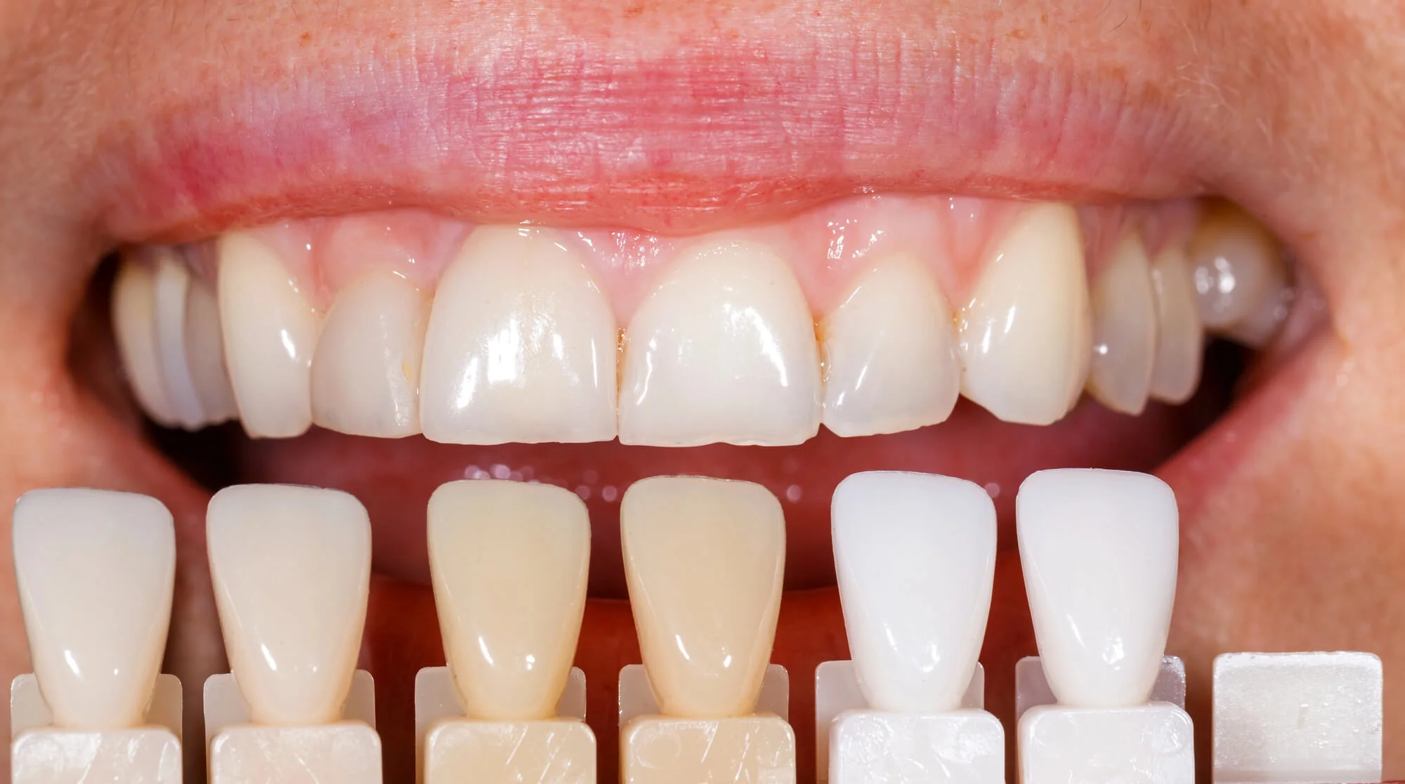 Shade matching for Mount Holly veneers